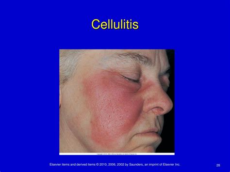 Cellulitis vs Fungal に対する画像結果