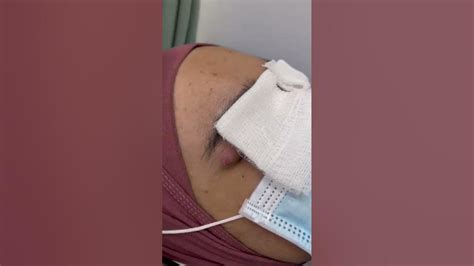 Exploding Pimple Pops に対する画像結果