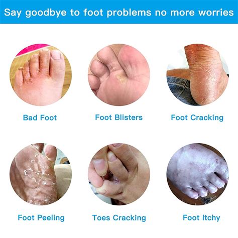 Image result for Foot Sweating Treatment