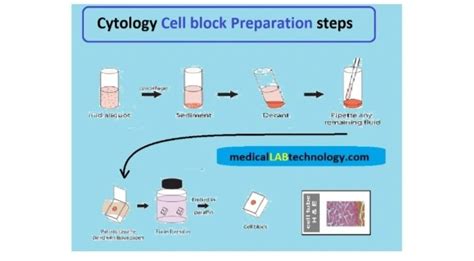 Cell Block Preparation From Different Body Fluids に対する画像結果