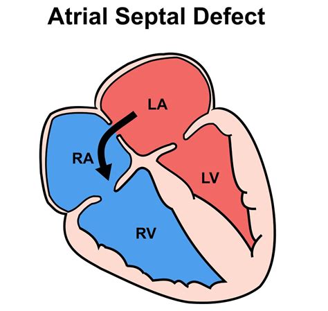 Toradh íomhá ar Ruis Atrium Septum Defect