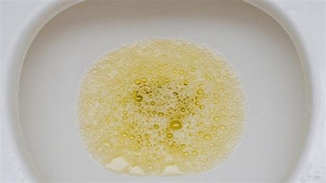 تصویر کا نتیجہ برائے Normal Urine Na