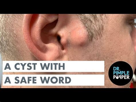 Gross Exploding Ear Pimple എന്നതിനുള്ള ഇമേജ് ഫലം