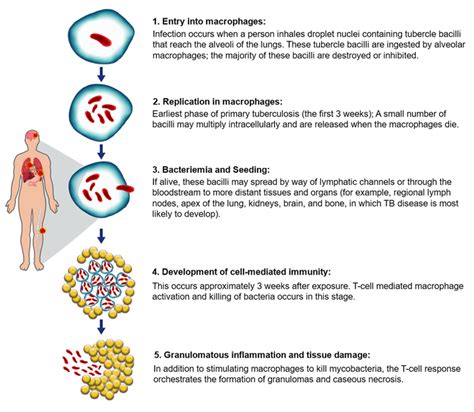 Image result for Tuberculosis Latent Stage