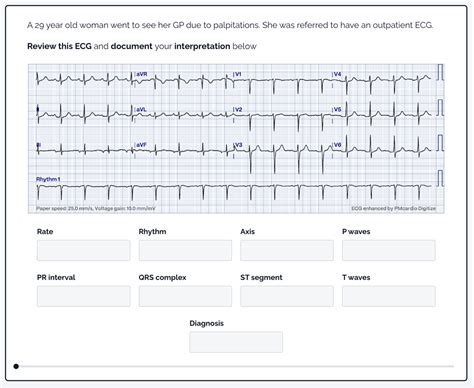 Afbeeldingsresultaten voor ECG Study