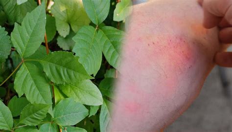 Rhus Dermatitis Face-এর ছবি ফলাফল