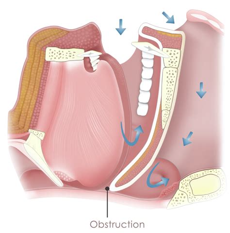 Image result for Sleep Apnea Airway Diagram