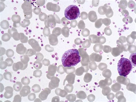 Afbeeldingsresultaten voor Bilobed Myelocyte