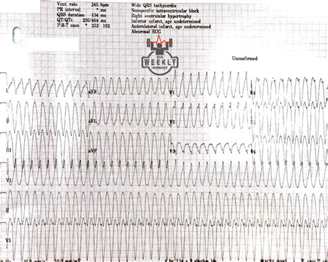 ACLS Wide Complex Tachycardia Algorithm に対する画像結果