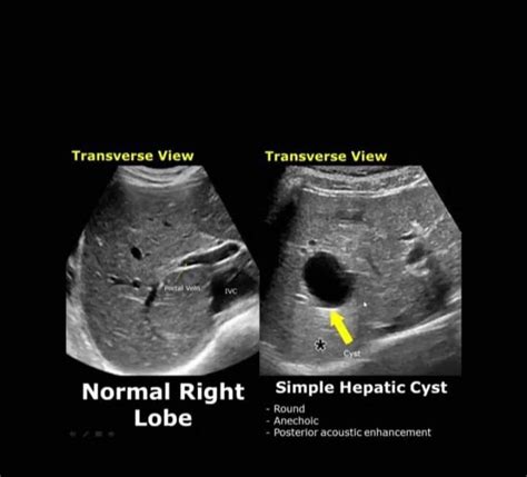 Simple Cyst On Ultrasound に対する画像結果