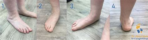 Image result for Pes Planovalgus