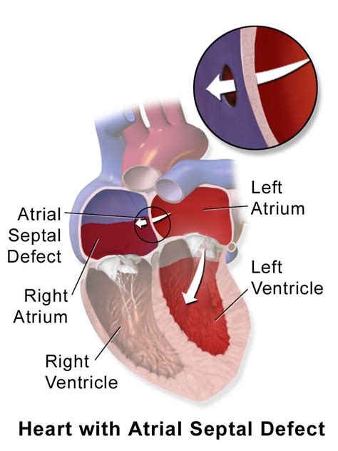 Toradh íomhá ar Ruis Atrium Septum Defect