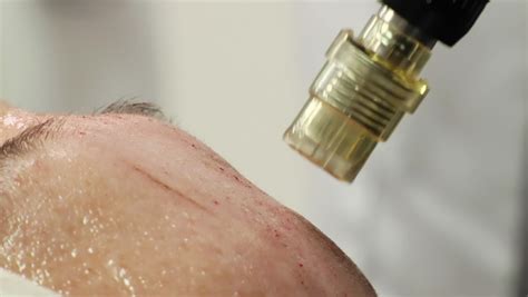 Image result for Micro Clip Procedure