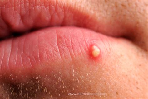 Image result for Lip Pimple Exploding