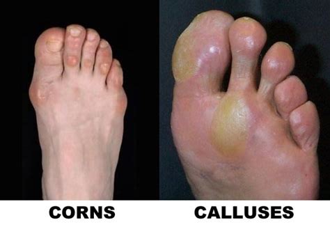 Afbeeldingsresultaten voor Red Calluses