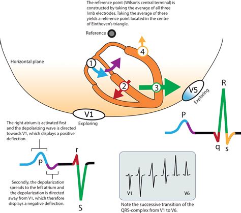 Image result for Negative Wave Deflection ECG