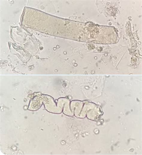 Urine Casts に対する画像結果