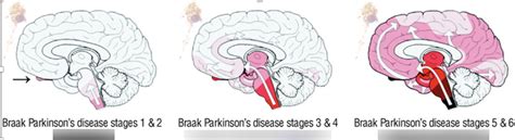 Image result for Sequence Diagram for Parkinson Disease
