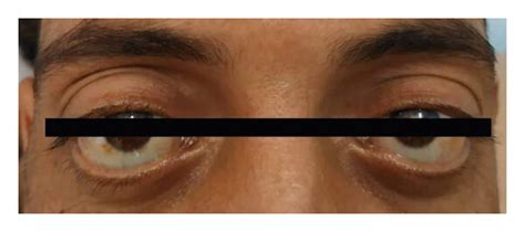 Image result for Exopthalmia