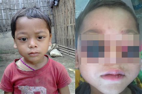 Image result for Eye Pops Out of Socket