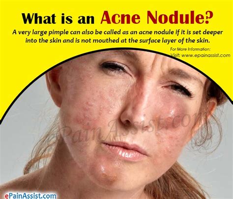 Inside Nodule Acne に対する画像結果