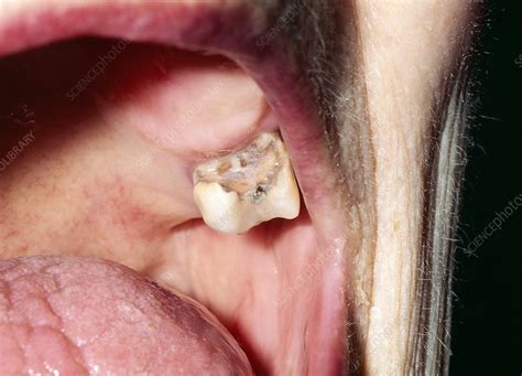 Image result for Broken Decayed Tooth