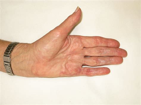 Toradh íomhá ar Digit Widget Finger