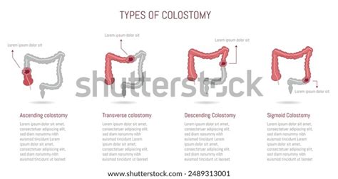 Image result for Types of Colostomy