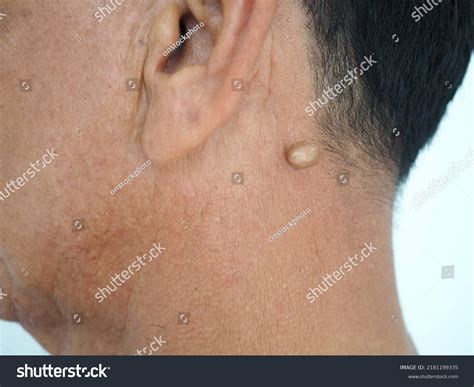 Lancing a Sebaceous Cyst に対する画像結果