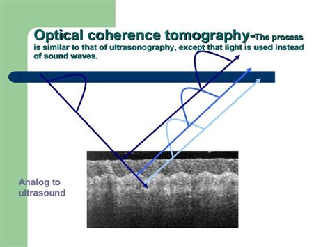 Image result for Optical Coherence Tomography Explained