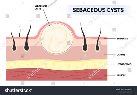 Image result for Sebaceous Cyst Pimple
