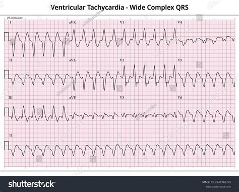 Image result for Wide Complex Tachycardia Algorithm