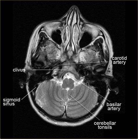 Image result for Normal Brain MRI Axial Labelled