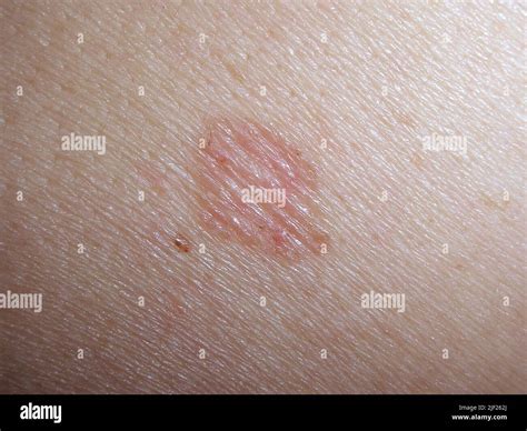 Afbeeldingsresultaten voor Basal Skin Cancer On Back