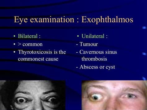 Image result for Exopthalmia