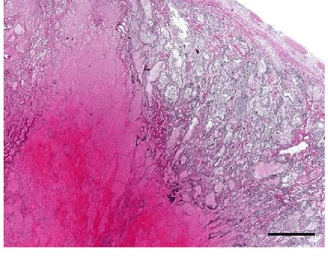 Image result for Overhang Tissue