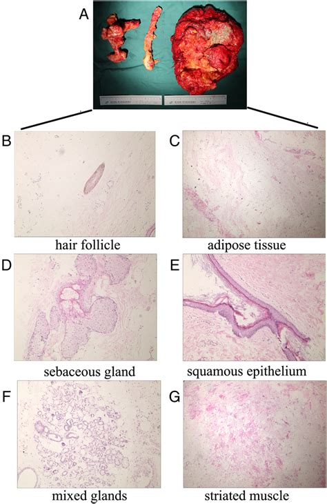 Image result for Teratoma