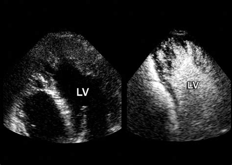 Image result for Echo Ultrasound Contrast