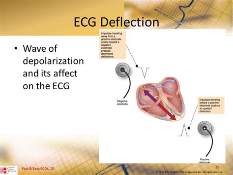 Image result for Negative Wave Deflection ECG
