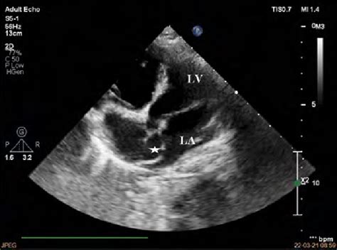 Image result for Ruis Atrium Septum Defect