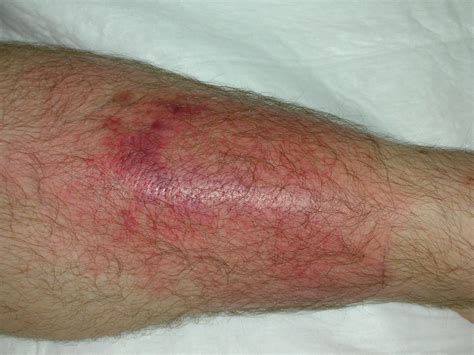 Image result for Cellulitis On Torso