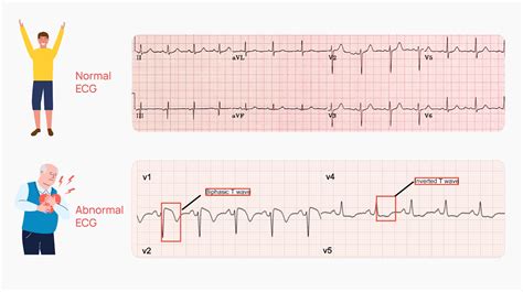 What Does a Normal ECG に対する画像結果