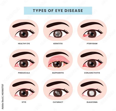 Set of different types of eye disease collection, Ophthalmology health ...