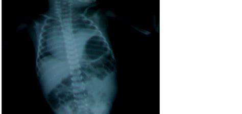 Image result for Eventration of Diaphragm Neonate