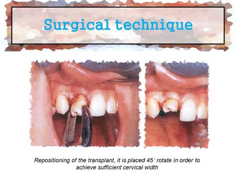 Tooth Transplantation に対する画像結果
