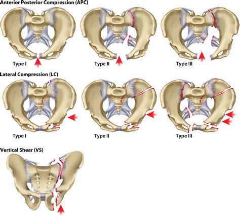 Afbeeldingsresultaten voor Pelvic Fracture Types