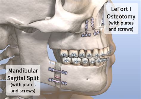 Mandibular Hyperplasia Surgery に対する画像結果
