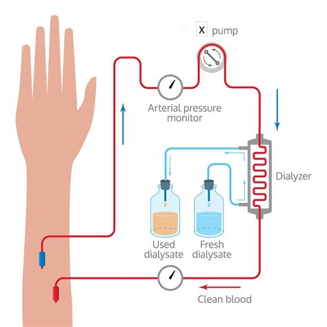 Image result for What Is Dialysis