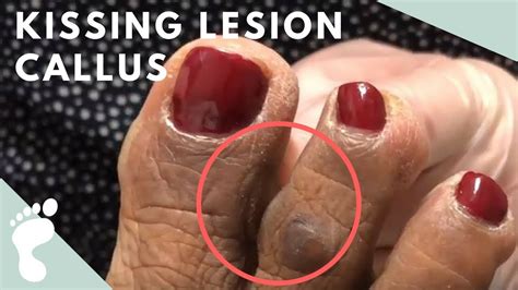 Image result for Toe Callus