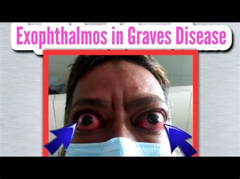 Image result for Exopthalmia